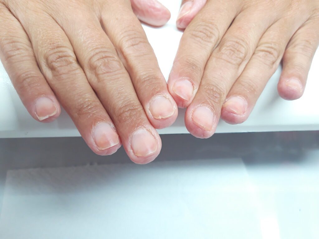 Problèmes d'ongles : ongles naturels fragilisés et affinés