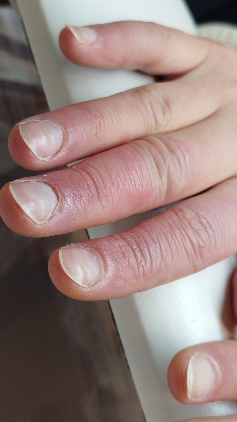 Avant / Après : Retrouver des Ongles naturels lisses et brillants quand ils sont bosselés